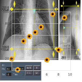 Costello syndrome