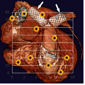 Splenogonadal fusion limb defects micrognatia