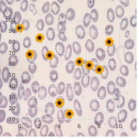 Proximal myotonic myopathy